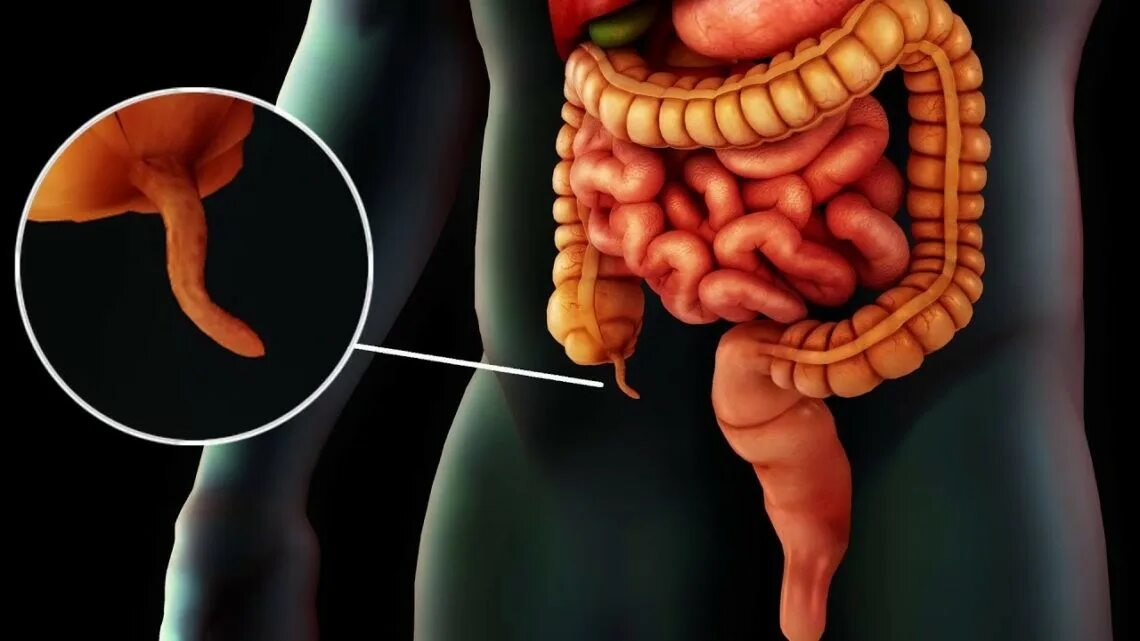 Аппендикс на теле. Флегмонозный аппендикс. Флегмонозный аппендицит отросток. Строение кишечника аппендикс.