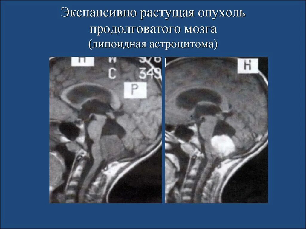 Рак ствола головного мозга. Новообразование в стволе головного мозга. Опухоль продолговатого мозга мрт. Объемное образование ствола головного мозга. Опухоль ствола головного мозга.