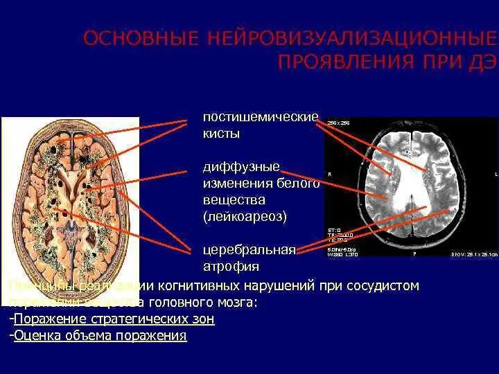 Постишемическая киста головного мозга. Лейкоареоз головного мозга. Постишемические лакунарные кисты. Нейровизуализация головного мозга при деменции.