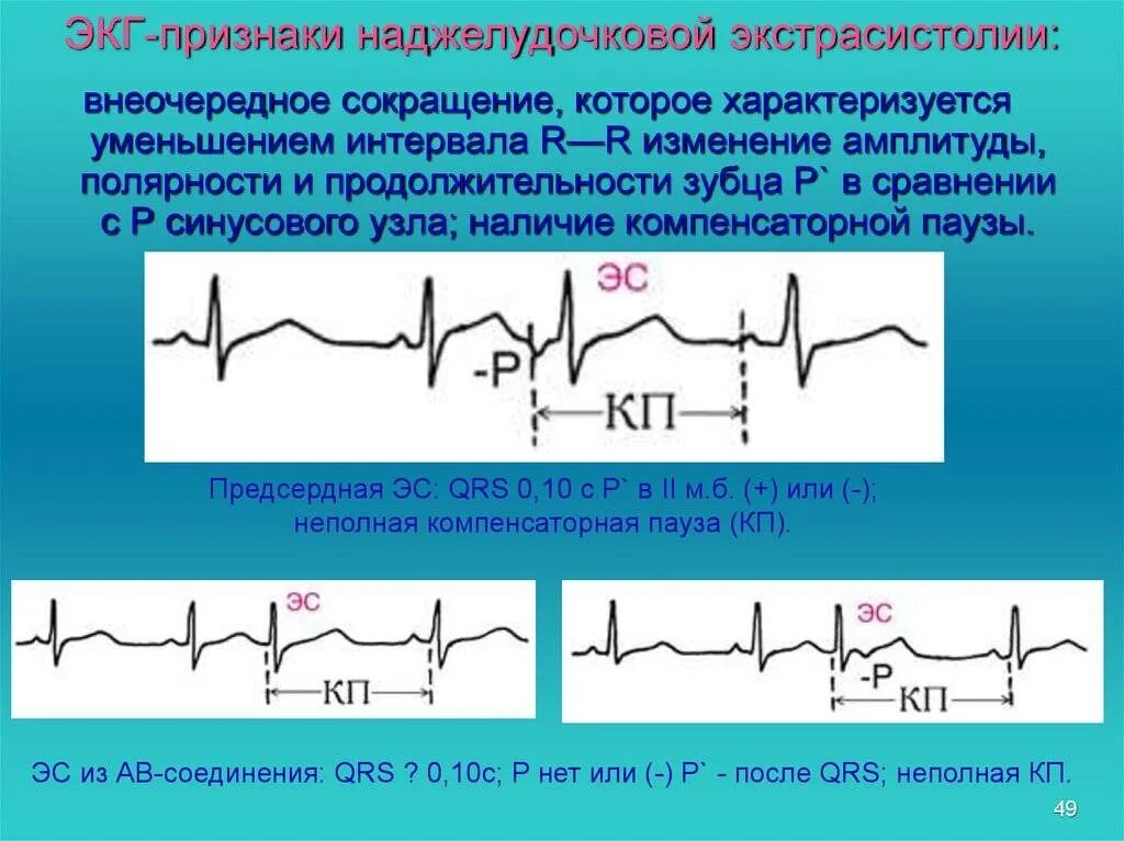 Одиночные наджелудочковые экстрасистолы. Наджелудочный экстрасистол. Наджелудочковая экстрасистолия на экг. Наджелудочный экстрасистол. Наджелудочковая экстрасистолия экг критерии.