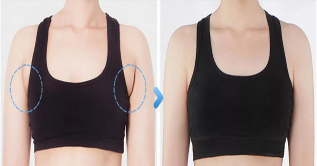 Гинекомастия липосакция. Молочная железа у мужчин. Эспандер после мастэктомии. Складки под лифчиком. Припухлости подмышками.