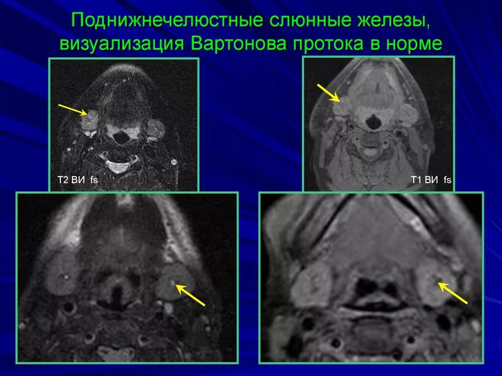 Образование околоушных желез. Аденома околоушной железы кт. Проток околоушной слюнной железы на кт. Сиалоаденит околоушной железы мрт. Проток околоушной железы на кт.