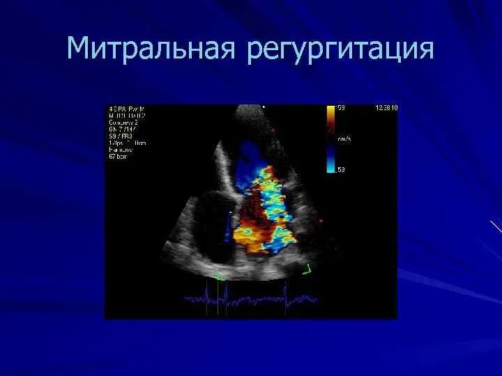 Митральная регургитация ЭХОКГ. ЭХОКГ митральная регургитация 1 степени. Митральная недостаточность регургитация. Митральная регургитация степени на ЭХОКГ.