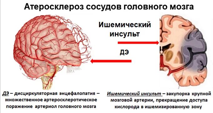 Лечение церебрального атеросклероза сосудов головного. Атеросклеротическое поражение сосудов головного мозга. Атеросклероз сосудов головного МОЗ. Атеросклероз артерий головного мозга. Проявления атеросклероза артерий головного мозга.