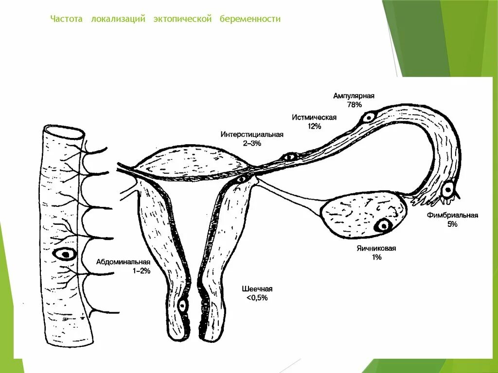 Забеременела без труб естественным путем. Локализация внематочной бер. Локализация трубной беременности. Частота локализации эктопической беременности. Классификация внематочной беременности по локализации.