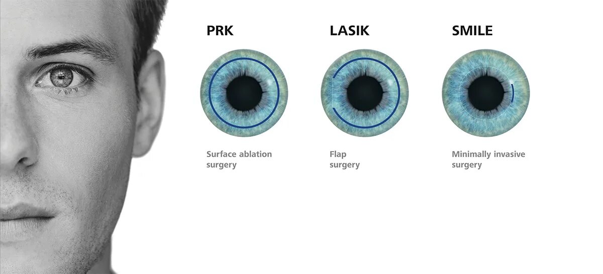 Коррекция зрения смайл цена со скидкой спектр. Лазерная операция на глаза Фемто ласик. Ласик (LASIK)/Фемто ласик (Femto LASIK). Лазерная коррекция методом Фемто ласик. Лазерная коррекция зрения ласик и ФЕМТОЛАСИК.