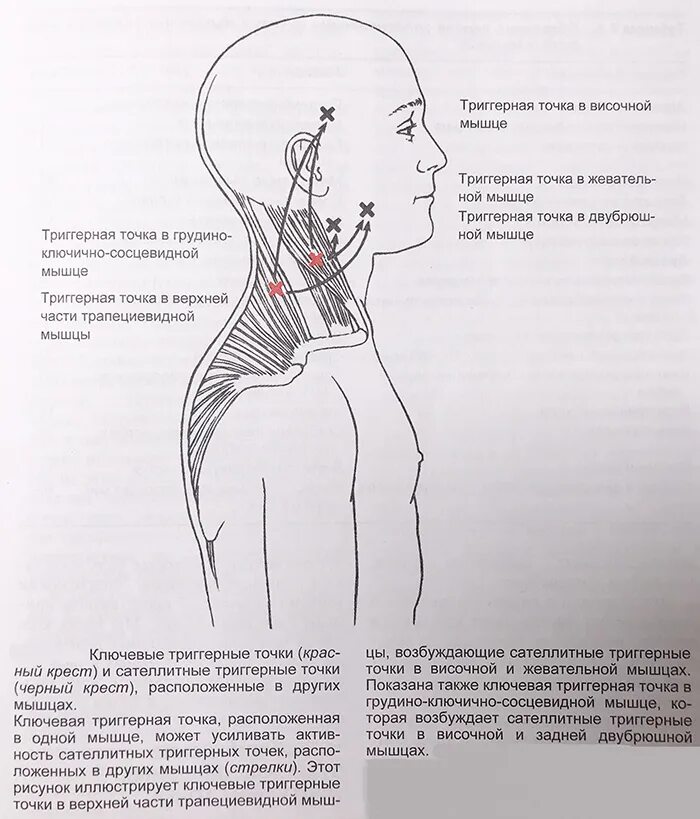 Мышцы шеи триггерные точки схема. Ременная мышца шеи триггерные точки. Тт1 триггерная точка. Ременная мышца головы триггерные точки. Триггерные точки это простыми словами