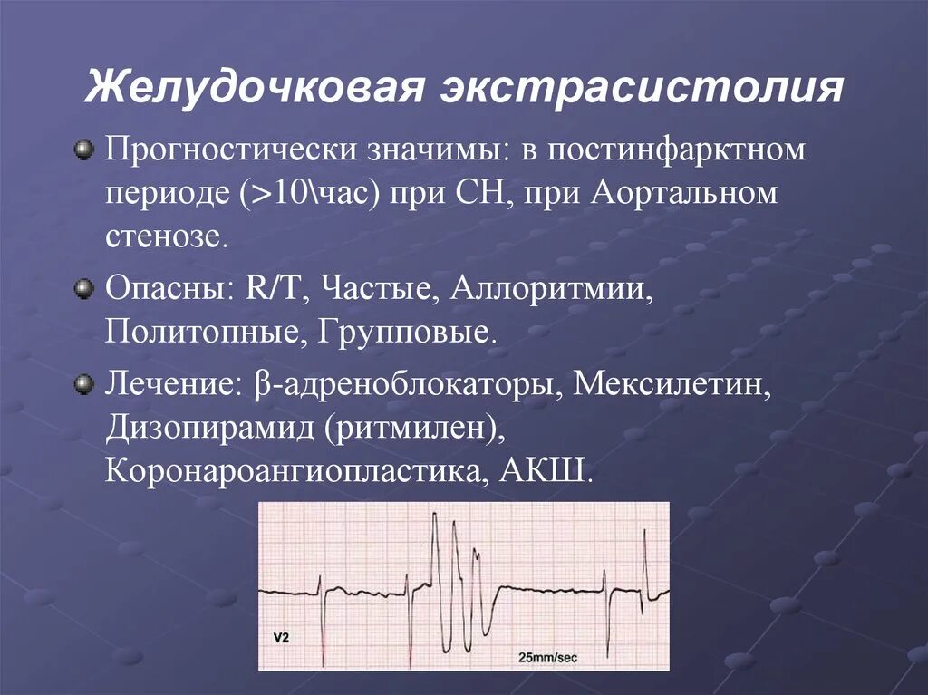 Аритмия желудочковая экстрасистолия. Желудочковая экстрасистолия клинические проявления. Частая желудочковая монотопная экстрасистолия ЭКГ. Мономорфная монотопная желудочковая экстрасистолия. Политопные экстрасистолы