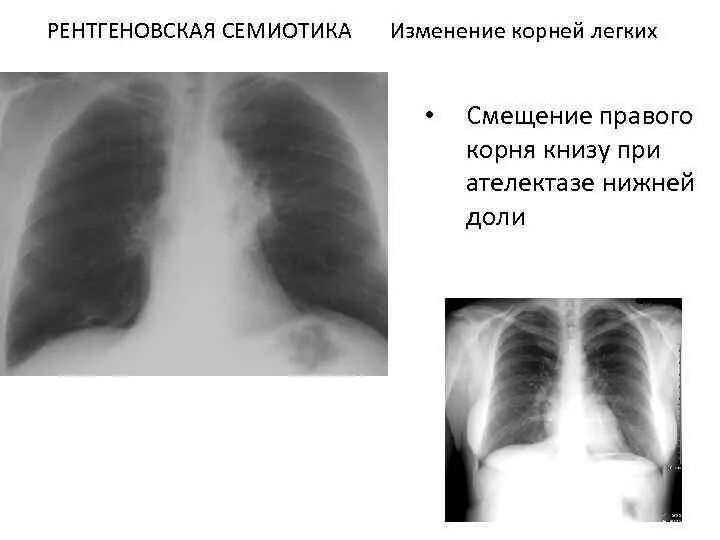 Смещение корня легкого. Образование корня легкого. Корень легкого рентген. Изменения корня легкого