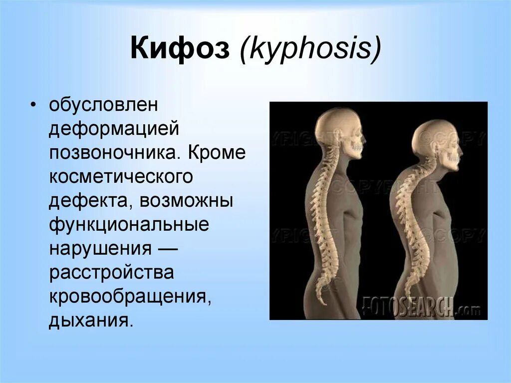 Кифотическая деформация позвоночника. Физиологический грудной кифоз. Кифоз позвонка. Патологический кифоз позвоночника.