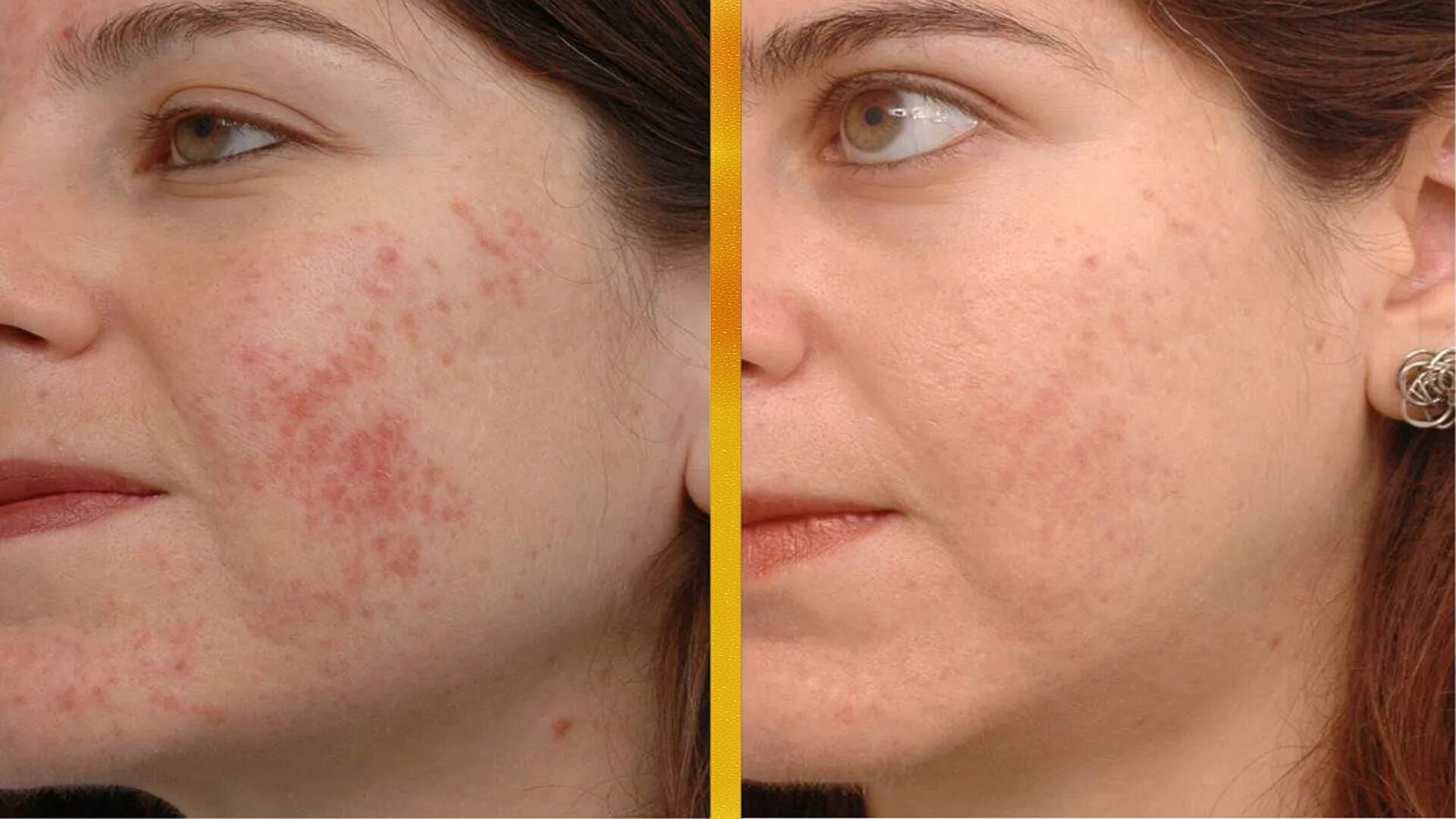 Пилинг при себорее. Алмазная шлифовка лица от постакне. Пилинг при себорее. Pca skin пилинги. Трихологический пилинг для кожи головы.