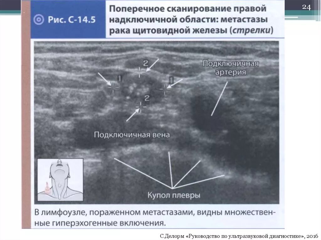 Метастазы при раке щитовидной железы