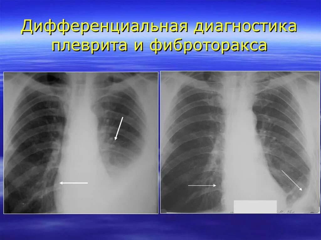 Шварты в легких это. Плевральная шварта рентген. Фиброторакс на рентгене. Фиброторакс рентгенодиагностика.