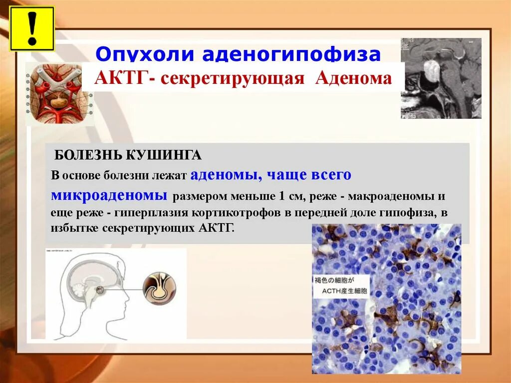 АКТГ-секретирующие аденомы. Аденома продуцирующая АКТГ. АКТГ продуцирующая опухоль.