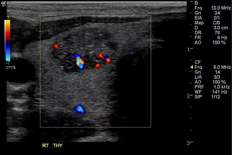 Можно ли перед узи щитовидной железы есть. Аденома щитовидной железы на УЗИ. Сонография щитовидной железы. Паращитовидные железы на УЗИ. Паращитовидная железа на УЗИ щитовидной железы.