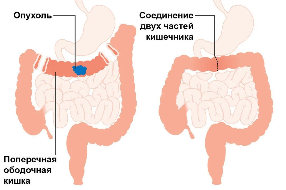 Рак кишечника прогноз