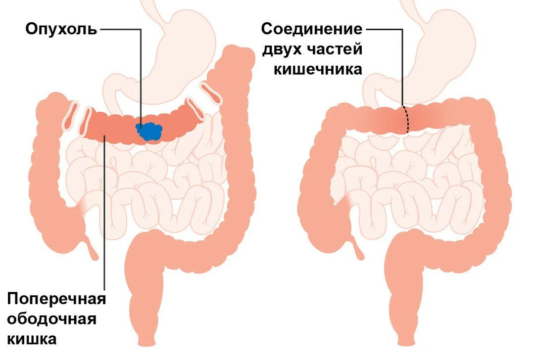 Опухоль ободочной кишки. Раковая опухоль кишечника. Злокачественная опухоль толстой кишки. Колэктомия это