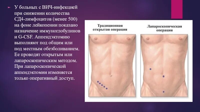 Язык при аппендиците. Актуальность аппендицита. Предвестники аппендицита.