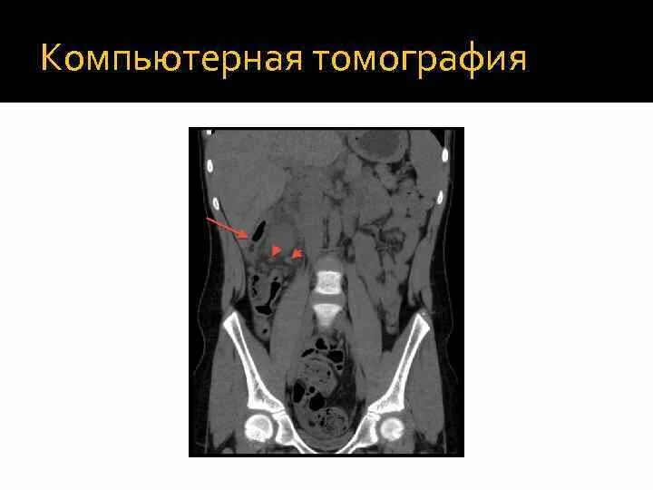 Абсцесс при аппендиците. Абсцесс брюшной полости на кт. периаппендикулярный абсцесс кт.