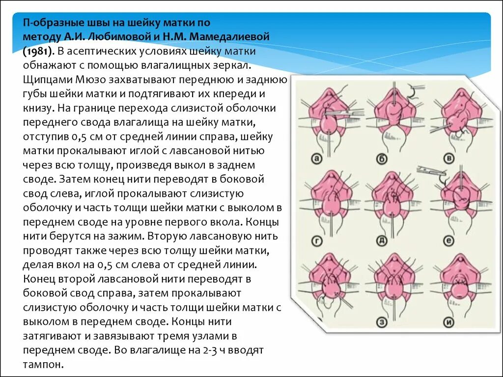 Удаление матки и половая жизнь. Наложение швов на шейку матки. Наложение шва при истмико-цервикальной недостаточности. Шов шейки матки при беременности.