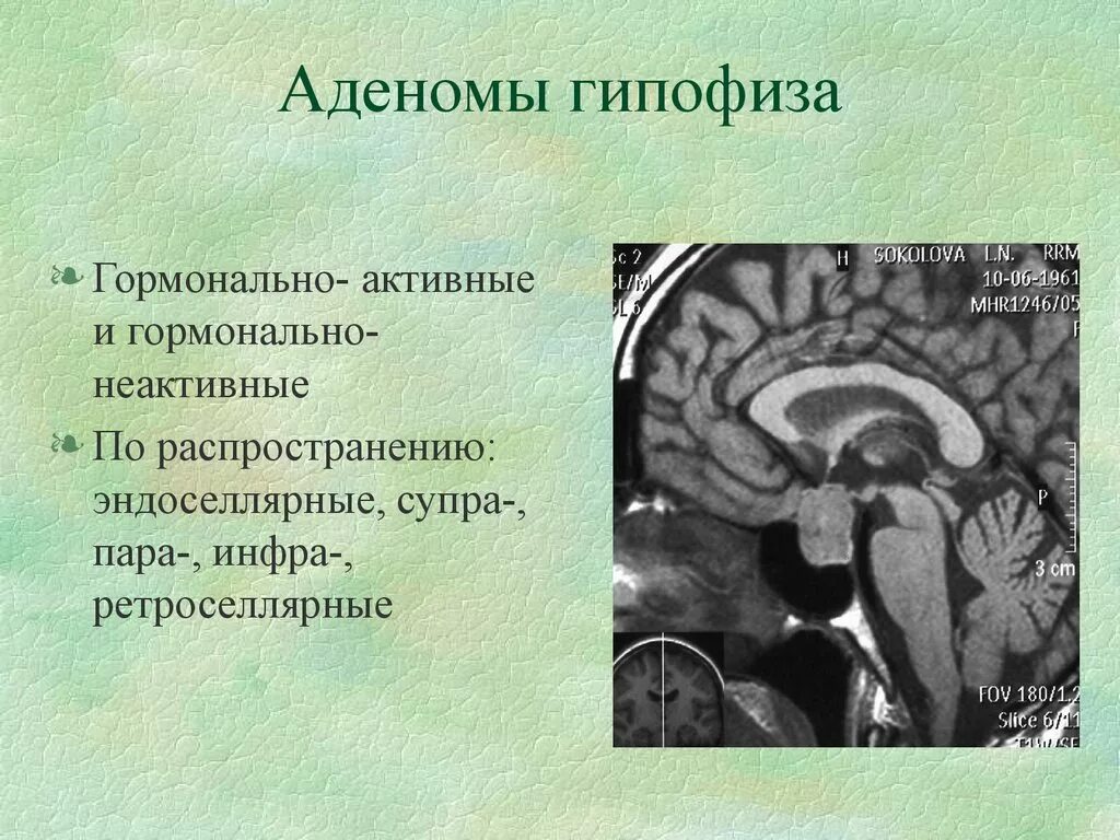 Опухоль гипофиза. Эндоселлярная аденома гипофиза головного мозга. Объемное образование гипофиза. Эозинофильной аденомы гипофиза.