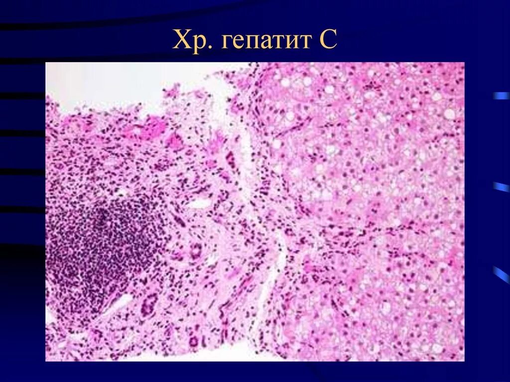 Микропрепарат патологическая анатомия. Гепатит печени микропрепарат. Цирроз печени патологическая анатомия макропрепарат. Хронический активный вирусный гепатит микропрепарат.