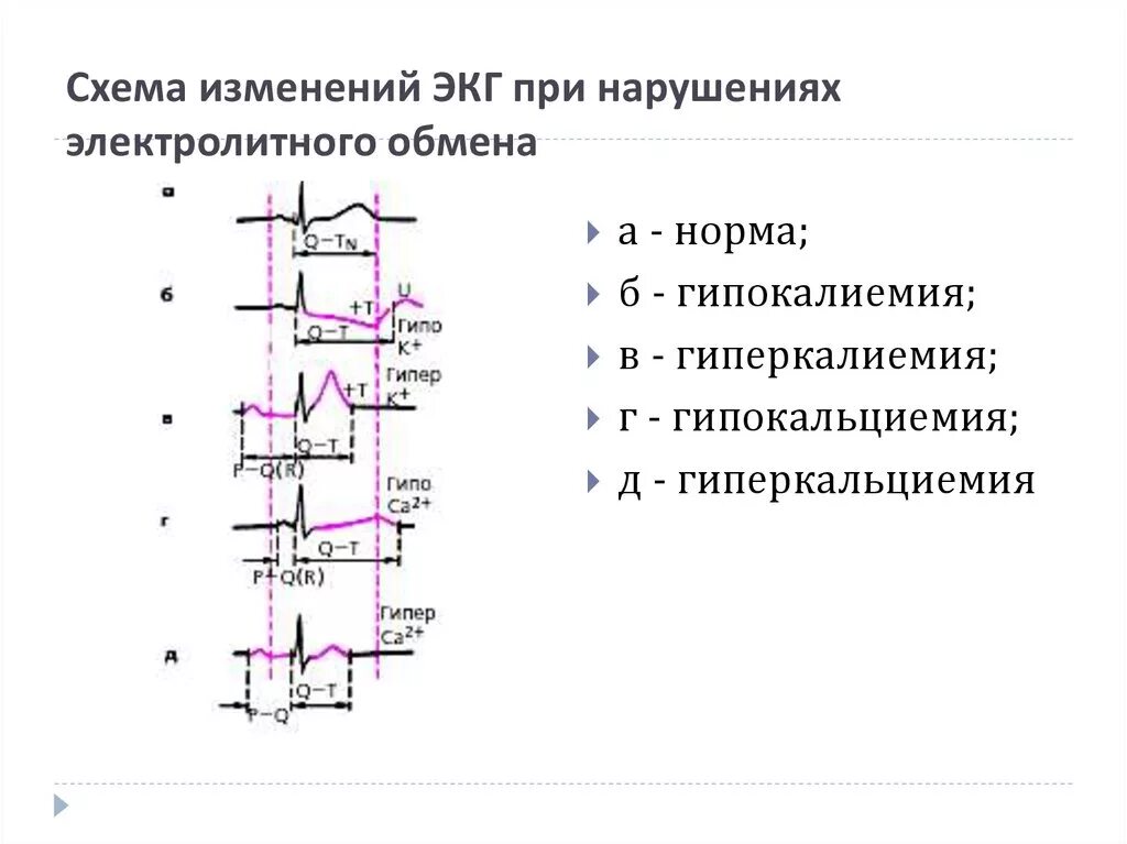 ЭКГ при нарушениях электролитного обмена. Изменения на ЭКГ при электролитных нарушениях. ЭКГ при электролитных нарушениях миокарда. Нарушение электролитного баланса на ЭКГ. Экг метаболические изменения что это значит