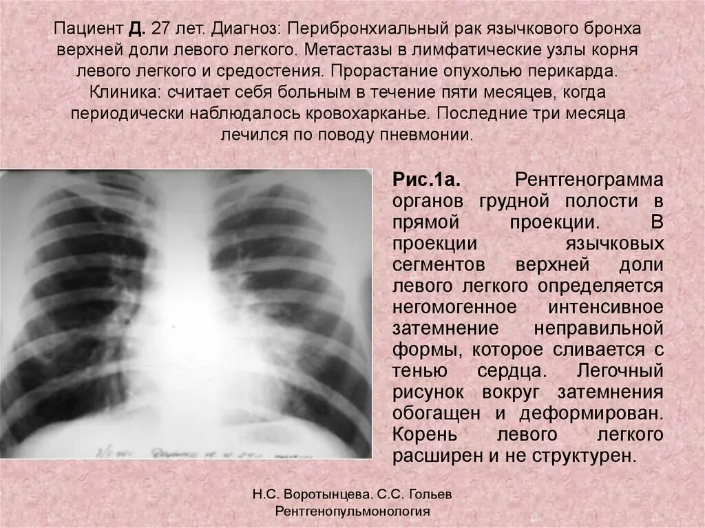 Перибронхиальная опухоль. Доли левого легкого. Деформация легочного рисунка на рентгене.