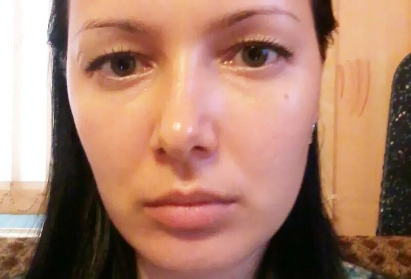 Болит на лице под глазом кость. Малярные мешки под глазами. Отеки на лице мешки на скулах. Мооярные мешочки под глазами. Болит скула под глазом.