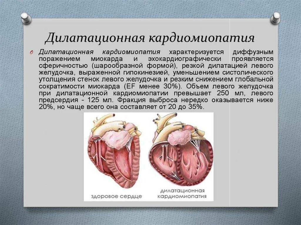 Кардиомиопатия что это такое. Кардиопатия дилатационная кардиомиопатия. кардиомиопатия левого желудочка. симптомы дилатационной кардиомиопатии. дилатационная гипертрофия миокарда.
