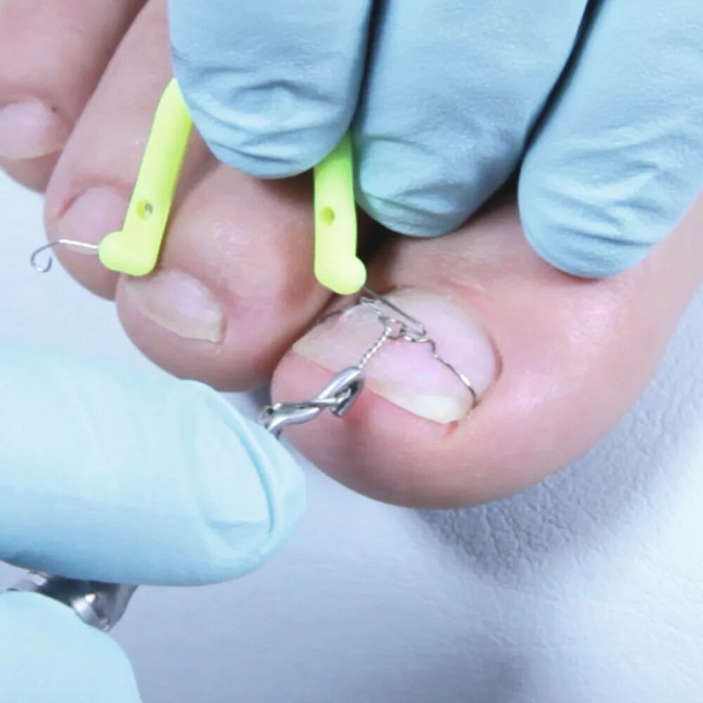 Скоба комбипед для вросшего ногтя. Титановая нить для педикюра. Ортониксия скоба пластина титановая нить. Подология титановая нить. Скоба наспан для вросших ногтей.