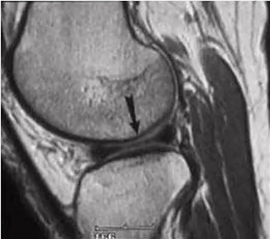 Мрт мениска коленного сустава. Повреждение медиального мениска коленного сустава мрт.