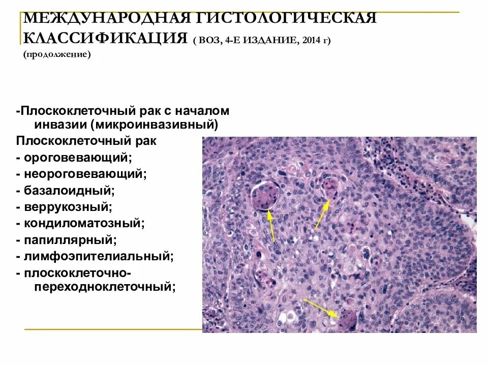 Плоскоклеточная карцинома шейки матки гистология. Аденокарцинома шейки матки гистология. Плоскоклеточная карцинома кожи гистология. Плоскоклеточный неороговевающий. Умеренно дифференцированный плоскоклеточный рак