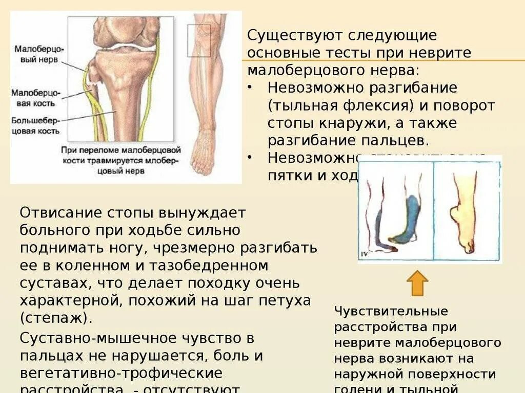 Малоберцовый нерв на стопе. Нейропатия малоберцового нерва симптомы. Поражение общего малоберцового нерва симптомы. Симптомы нейропатии малоберцового нерва. Нейропатия справа