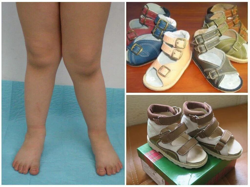 Вальгус какую обувь. Ортопедическая обувь для детей при плосковальгусной деформации стоп. Обувь при вальгусной деформации стопы у детей 1 год. Ортопедическая обувь при вальгусной деформации стоп для женщин. Ортопедические стельки Варус вальгус.