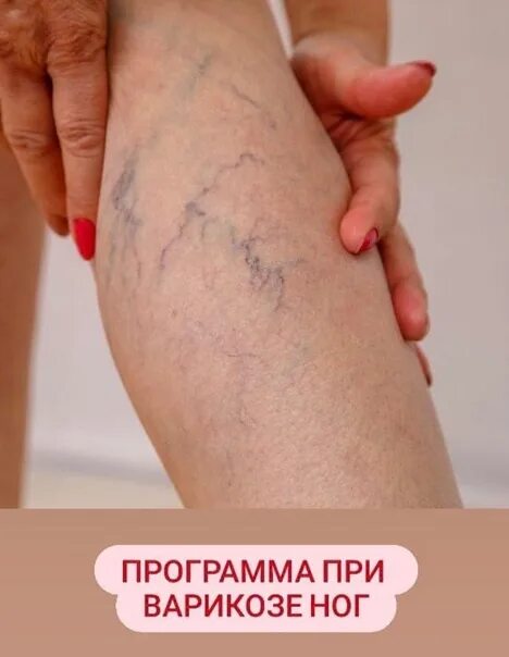 Как выглядят лопнувшие капилляры на ногах Как выглядят лопнувшие капилляры на ногах