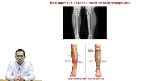Перелом костей голени мкб