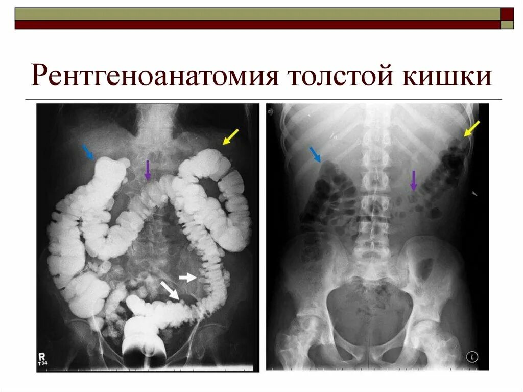 Исследование прямой и сигмовидной кишки. Рентген анатомия Толстого кишечника. Ободочная кишка рентген. Отделы толстой кишки рентген. Рентгеноанатомия толстой кишки.