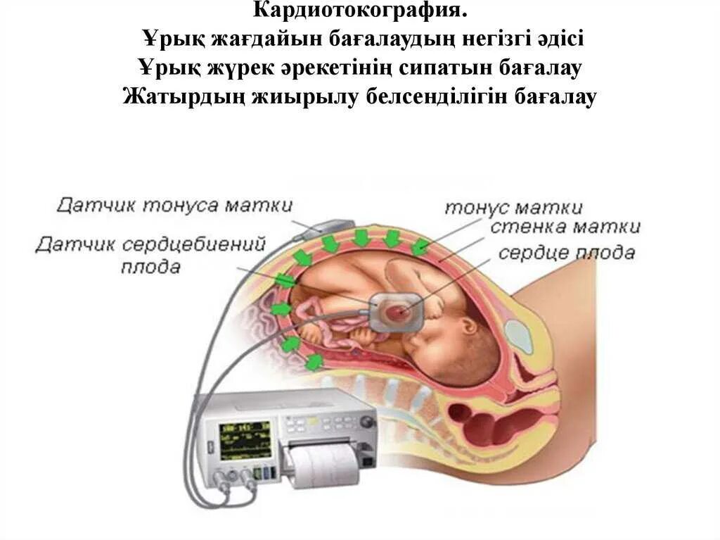 Тонус 33 недели