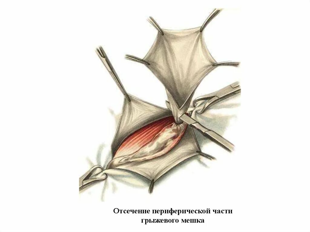 Пластика паховой грыжи по Лихтенштейну. Лихтенштейн операция паховая грыжа. Операция Лихтенштейна при паховой грыже. Лихтенштейн операция паховая