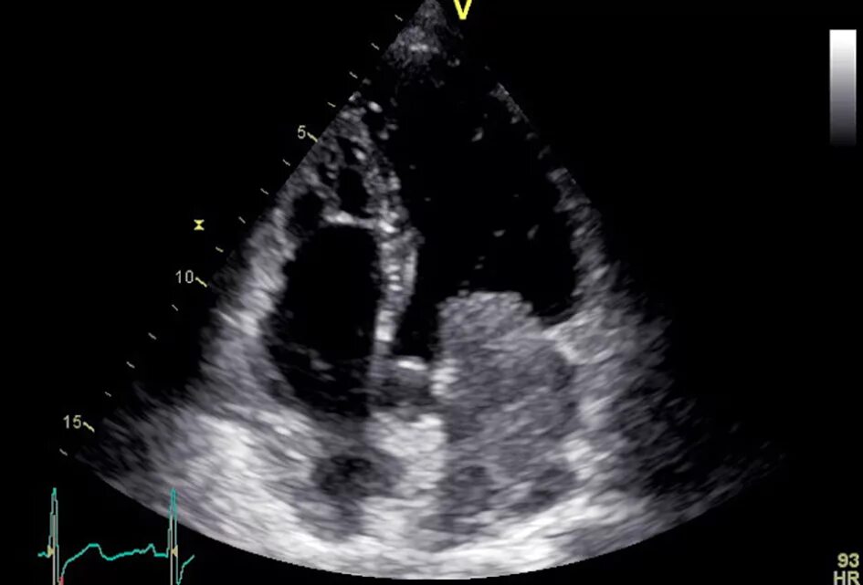 Ультразвуковое исследование сердца - эхокг что это. Цветное допплеровское картирование сердца. Ультразвуковое исследование узи сердца что такое?. Узи сердца эхокг. Узи сердца норма снимок.