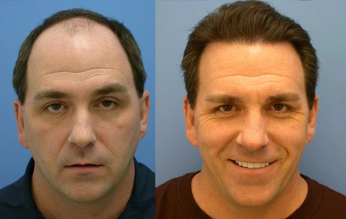 Живот до и после похудения мужчины. Операция смас лифтинг операция. До и после пересадки волос. Липо абдоминопластика. Результат после операции.