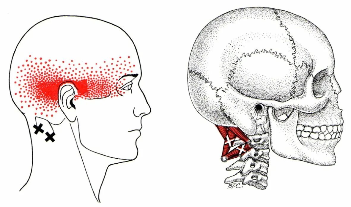 Сильные височные боли. Миофасциальные триггерные точки шея голова. Подзатылочные мышцы триггерные точки. Ременная мышца триггерные точки. Триггерные точки мышц головы.