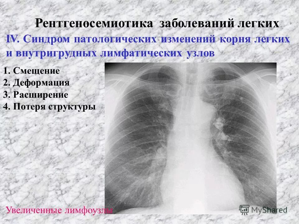 Что означает изменения в легких. Синдром патологии легочного рисунка. Заболевания корня легкого. Корни лёгких на рентгенограмме.