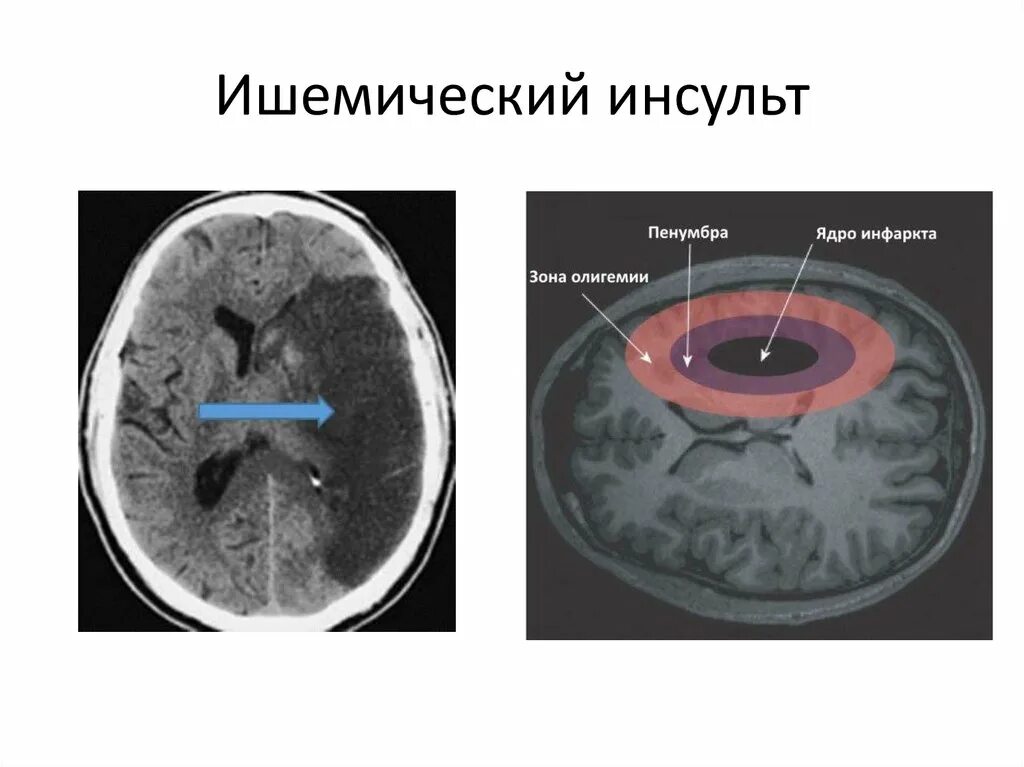 Цереброваскулярные заболевания. Зрачки при ишемическом инсульте. Цереброваскулярные патологии.