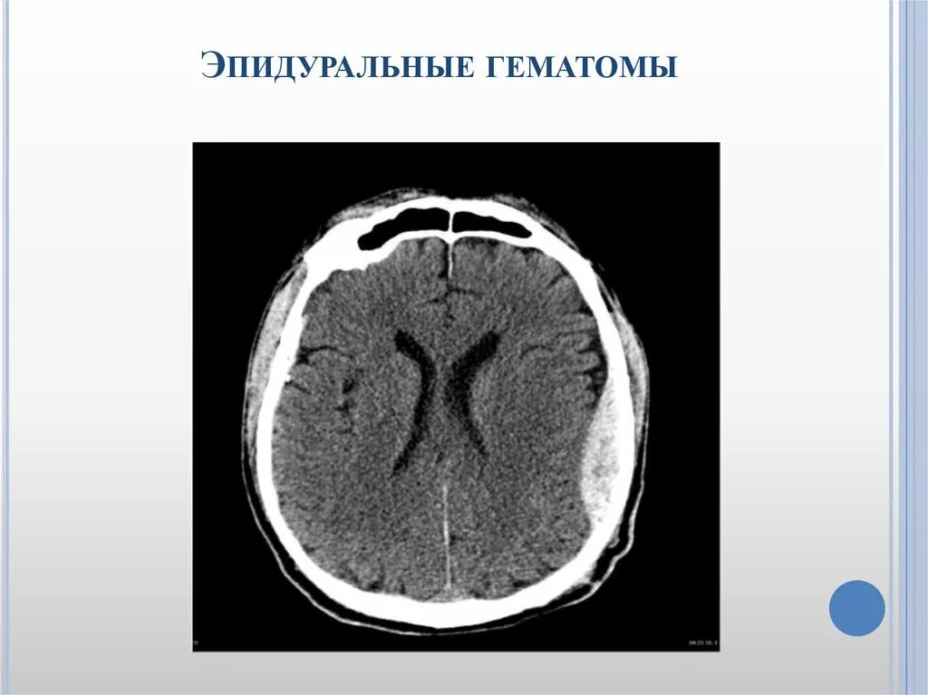 Черепно мозговые гематомы. Субдуральная и эпидуральная гематома. Хроническая субдуральная гематома на кт. Подострая эпидуральная гематома. Субдуральная и эпидуральная гематома кт.