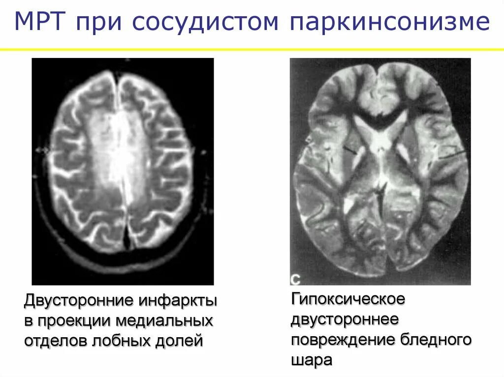 Болезнь Паркинсона на мрт головного мозга. Болезнь Паркинсона мрт признаки. Кт головного мозга при паркинсоне. Болезнь Паркинсона мрт картина.