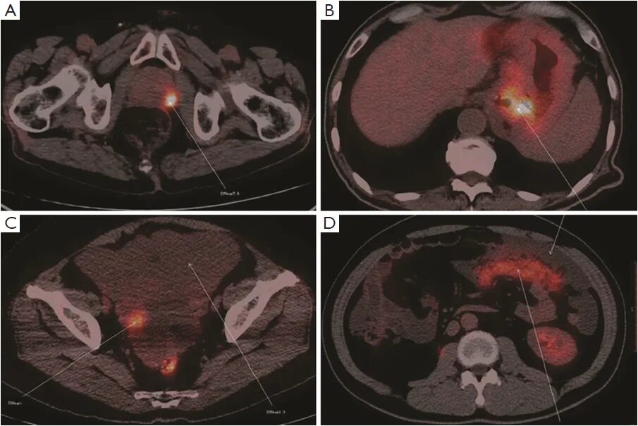 Метастазы в печени на ПЭТ кт. ПЭТ кт 18 ФДГ брюшной полости. SUVMAX печени нормальные показатели при ПЭТ кт. Рфп при пэт кт