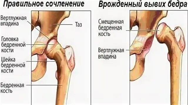 Код мкб вывих тазобедренного сустава. Врожденный вывих тазобедренного сустава. дисплазия вывих тазобедренного сустава. классификация дисплазии вертлужной впадины. дисплазия головки бедренной кости.
