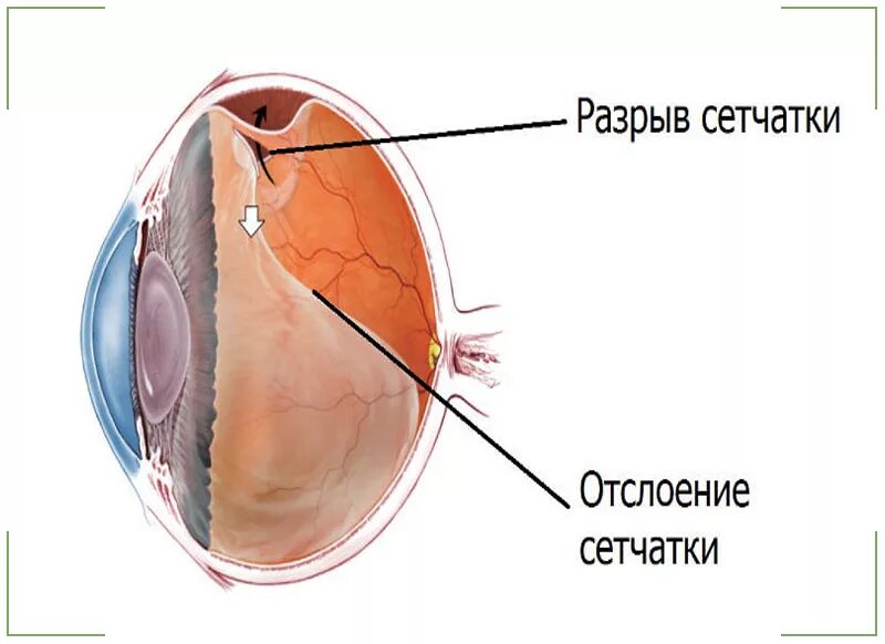 Регматогенная отслойка сетчатки глаза. Клапанный разрыв отслойка сетчатки. Травматическое отслоение сетчатки. Дырчатый разрыв сетчатки. Повреждение сетчатки